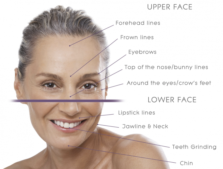 botox injection sites