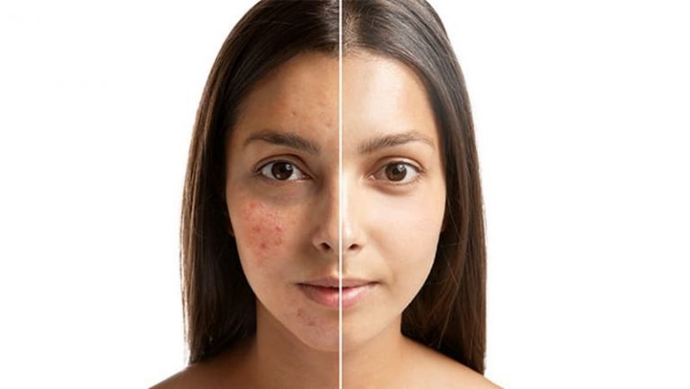 acne treatment Austin tx