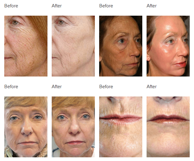 CO2 Laser results at Auveau