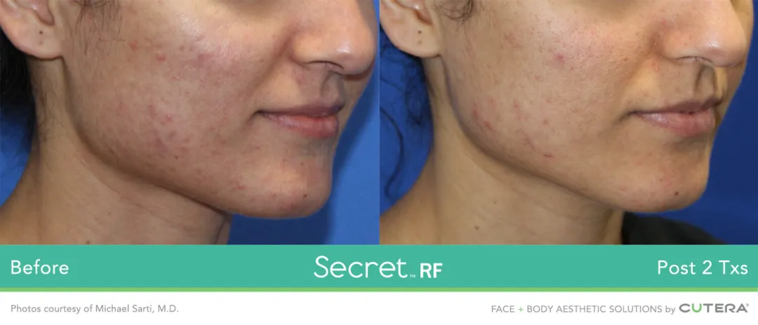 Secret RF results at Auveau