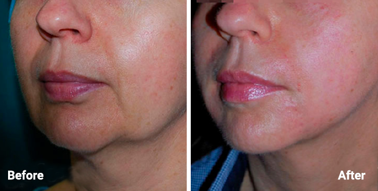 Morpheus8 treatment at Auveau Aesthetics in West Lake Hills