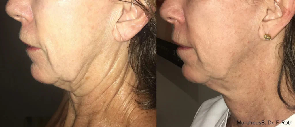 Morpheus8 treatment results at Auveau