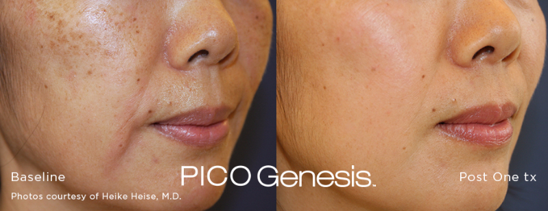 Pico Genesis results at Auveau