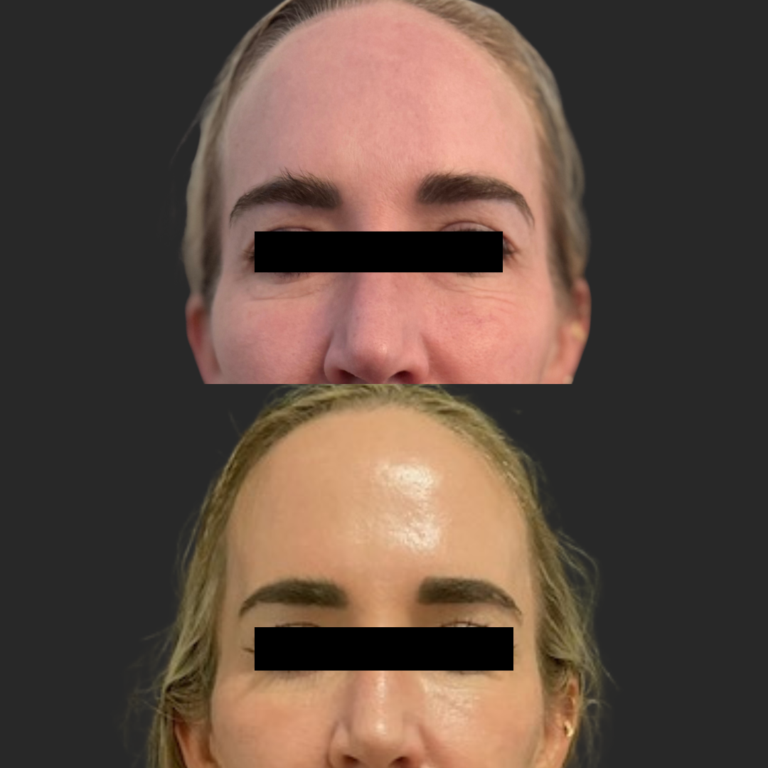 Acclaro UltraClear treatment at Auveau Aesthetics in West Lake Hills