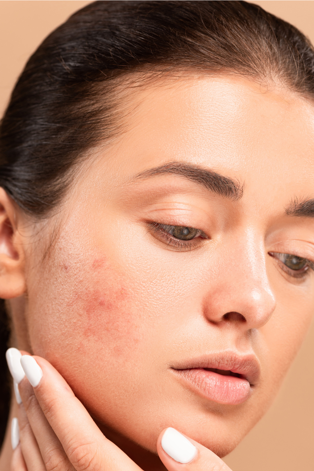 AviClear treatment at Auveau Aesthetics in West Lake Hills