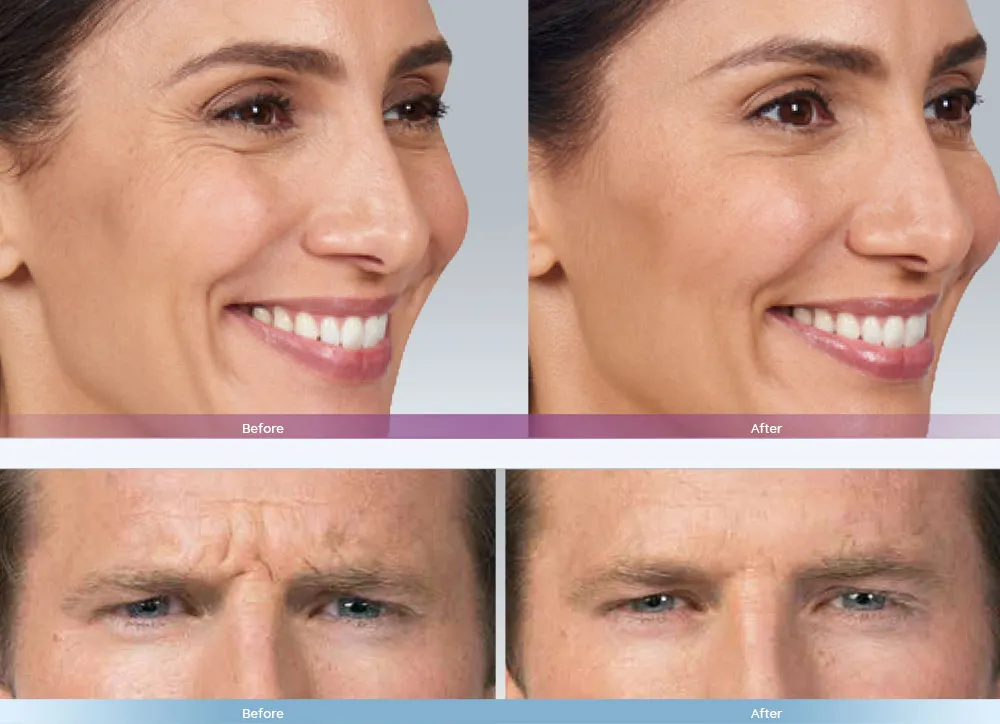 Botox treatment before and after comparison at Auveau