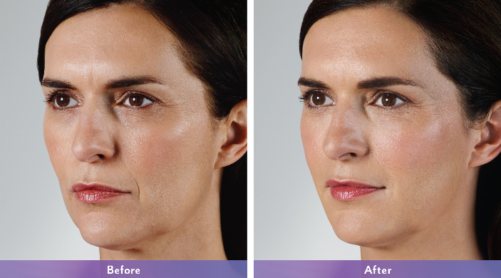 Juvederm treatment before and after comparison at Auveau