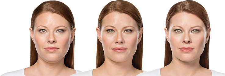 Kybella treatment before and after comparison at Auveau