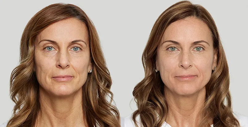 Sculptra treatment before and after comparison at Auveau