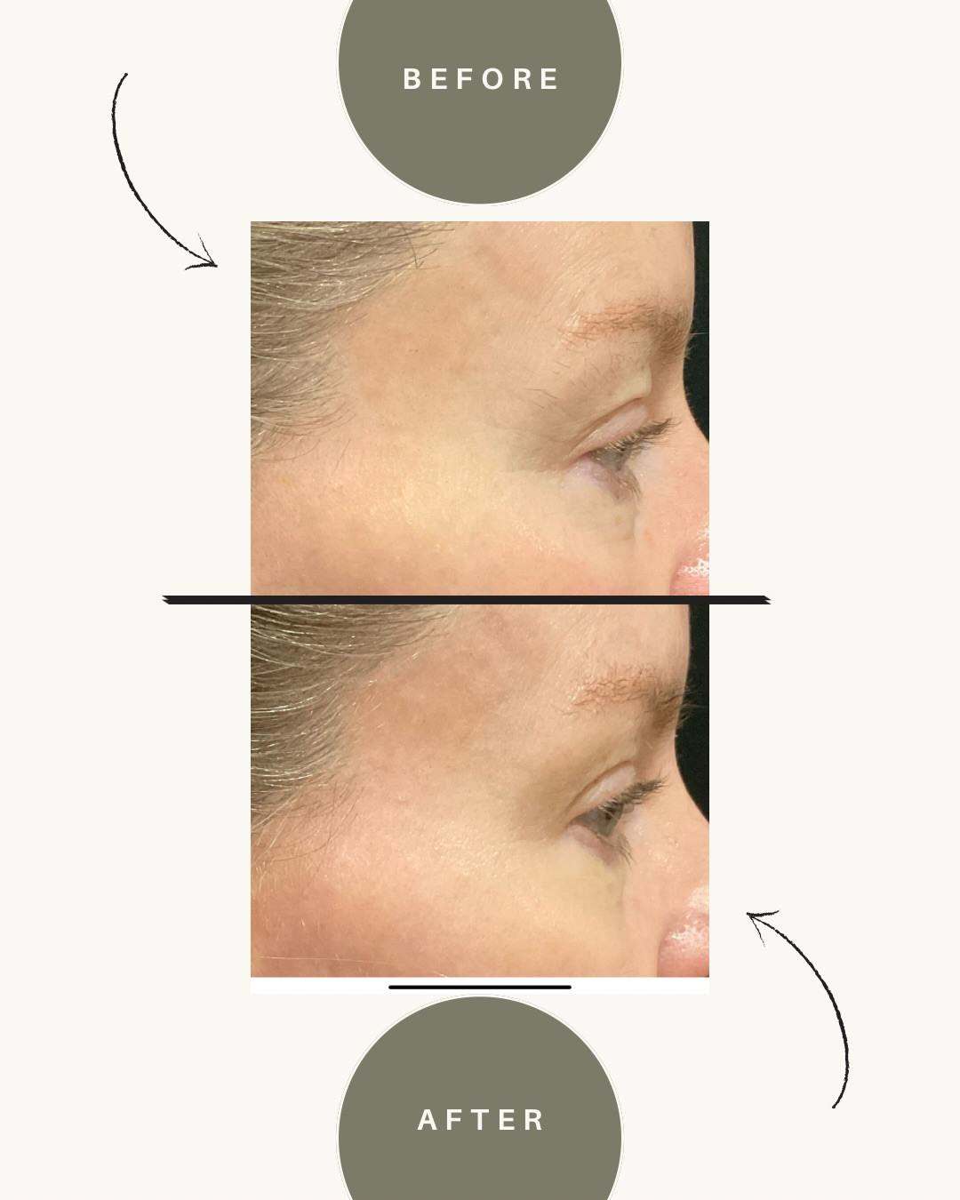 XERF before and after — brow and under-eye area, Auveau Medspa