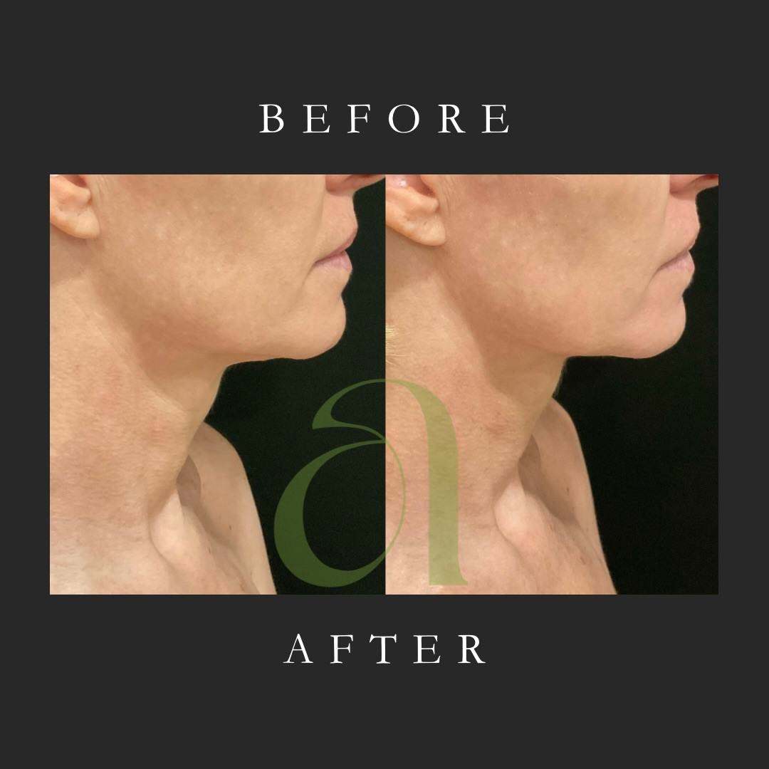 XERF RF skin tightening before and after — neck and jawline, Auveau Medspa